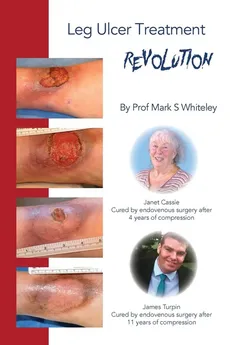 Leg Ulcer Treatment Revolution - Mark S Whiteley