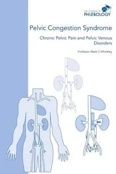 Pelvic Congestion Syndrome - Chronic Pelvic Pain and Pelvic Venous Disorders - Mark S Whiteley