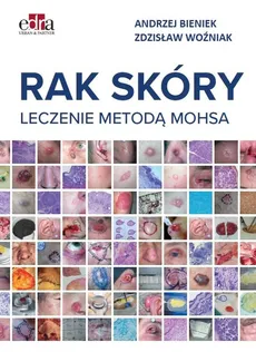 Rak skóry Leczenie metodą Mohsa - Andrzej Bieniek, Zdzisław Woźniak