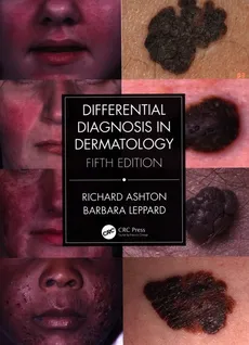Differential Diagnosis in Dermatology - Richard Ashton, Barbara Leppard