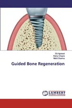 Guided Bone Regeneration - Eiti Agrawal