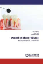 Dental Implant Failures - Birood Patel