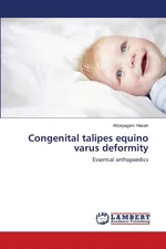 Congenital talipes equino varus deformity - Alizayagam Hasan