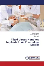 Tilted Versus Nontilted Implants In An Edentulous Maxilla - Shikha Punjani