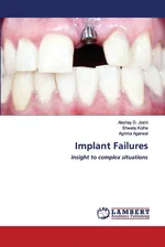 Implant Failures - Akshay D. Joshi