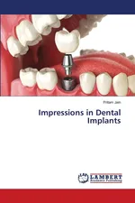 Impressions in Dental Implants - Pritam Jain