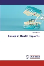 Failure in Dental Implants - Prince Kumar
