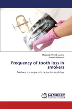 Frequency of Tooth Loss in Smokers - Maqsood Ahmed Soomro