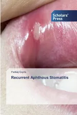Recurrent Aphthous Stomatitis - Pankaj Gupta