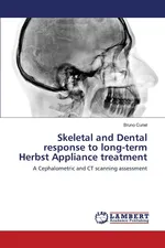 Skeletal and Dental response to long-term Herbst Appliance treatment - Bruno Curiel