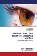 Mooren's ulcer and peripheral ulcerative keratitis - Vipul Bhandari