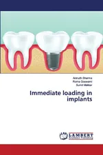 Immediate loading in implants - Anirudh Sharma