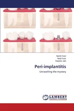 Peri-implantitis - Navnit Kaur