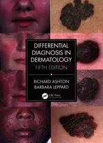 Differential Diagnosis in Dermatology - Richard Ashton