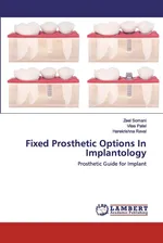 Fixed Prosthetic Options In Implantology - Zeel Somani