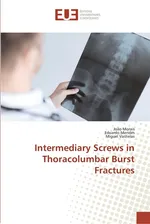 Intermediary Screws in Thoracolumbar Burst Fractures - Joao Morais