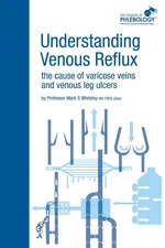 Understanding Venous Reflux the Cause of Varicose Veins and Venous Leg Ulcers - Mark S. Whiteley
