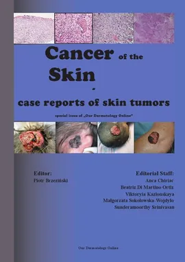 Cancer of the Skin - case reports of skin tumors - nowa klasyfikacja raków skóry - Piotr Brzezinski