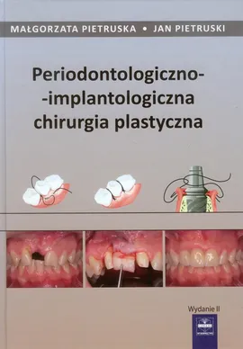Periodontologiczno-implantologiczna chirurgia plastyczna - Małgorzata Pietruska, Jan Pietruski