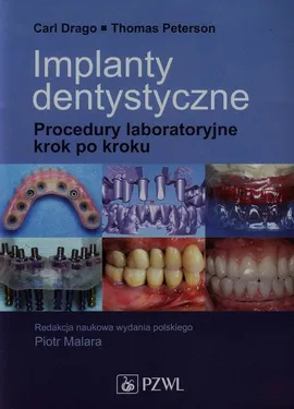 Implanty dentystyczne - Outlet - Carl Drago, Thomas Peterson